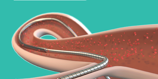 redwire medical guidewire 